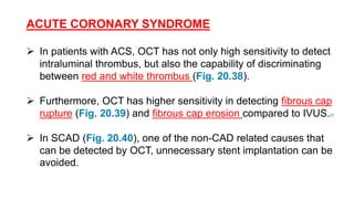 ACUTE CORONARY SYNDROME
 In patients with ACS, OCT has not only high sensitivity to detect
intraluminal thrombus, but also the capability of discriminating
between red and white thrombus (Fig. 20.38).
 Furthermore, OCT has higher sensitivity in detecting fibrous cap
rupture (Fig. 20.39) and fibrous cap erosion compared to IVUS.97
 In SCAD (Fig. 20.40), one of the non-CAD related causes that
can be detected by OCT, unnecessary stent implantation can be
avoided.
 