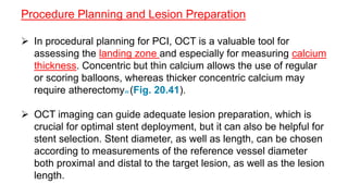 Procedure Planning and Lesion Preparation
 In procedural planning for PCI, OCT is a valuable tool for
assessing the landing zone and especially for measuring calcium
thickness. Concentric but thin calcium allows the use of regular
or scoring balloons, whereas thicker concentric calcium may
require atherectomy98 (Fig. 20.41).
 OCT imaging can guide adequate lesion preparation, which is
crucial for optimal stent deployment, but it can also be helpful for
stent selection. Stent diameter, as well as length, can be chosen
according to measurements of the reference vessel diameter
both proximal and distal to the target lesion, as well as the lesion
length.
 