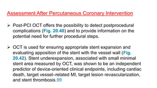 Assessment After Percutaneous Coronary Intervention
 Post-PCI OCT offers the possibility to detect postprocedural
complications (Fig. 20.40) and to provide information on the
potential need for further procedural steps.
 OCT is used for ensuring appropriate stent expansion and
evaluating apposition of the stent with the vessel wall (Fig.
20.42). Stent underexpansion, associated with small minimal
stent area measured by OCT, was shown to be an independent
predictor of device-oriented clinical endpoints, including cardiac
death, target vessel–related MI, target lesion revascularization,
and stent thrombosis.99
 