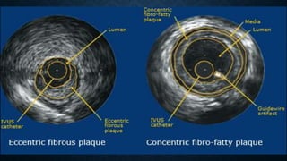 IVUS | PPTX
