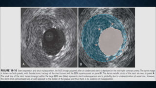 IVUS | PPTX