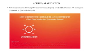 ACUTE MALAPPOSITION
• Acute malapposition was detected by OCT more than twice as frequently as with IVUS: 14% versus 39% in study and
19.3% versus 38.5% in ILUMIEN III trial.
 