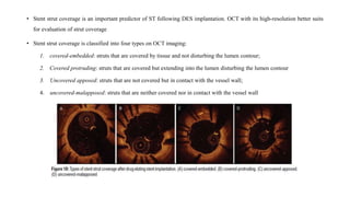• Stent strut coverage is an important predictor of ST following DES implantation. OCT with its high-resolution better suits
for evaluation of strut coverage
• Stent strut coverage is classified into four types on OCT imaging:
1. covered-embedded: struts that are covered by tissue and not disturbing the lumen contour;
2. Covered protruding: struts that are covered but extending into the lumen disturbing the lumen contour
3. Uncovered apposed: struts that are not covered but in contact with the vessel wall;
4. uncovered-malapposed: struts that are neither covered nor in contact with the vessel wall
 
