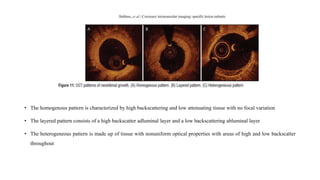 • The homogenous pattern is characterized by high backscattering and low attenuating tissue with no focal variation
• The layered pattern consists of a high backscatter adluminal layer and a low backscattering abluminal layer
• The heterogeneous pattern is made up of tissue with nonuniform optical properties with areas of high and low backscatter
throughout
 