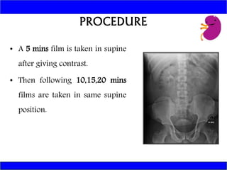 INTRAVENOUS UROGRAM | PPTX | Medical Tests | Medical Health