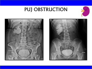INTRAVENOUS UROGRAM | PPTX