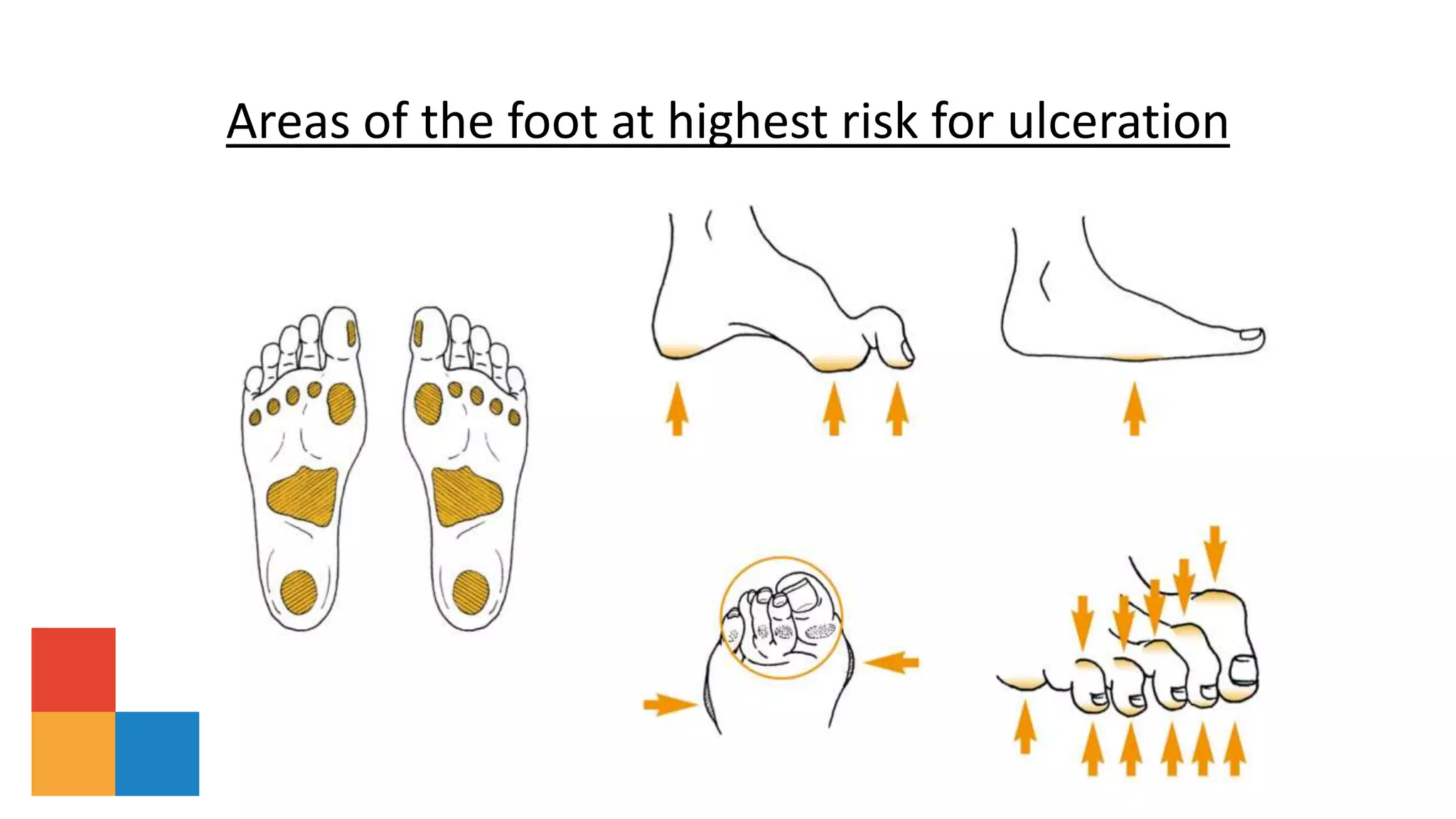 Areas of the foot at highest risk for ulceration
 