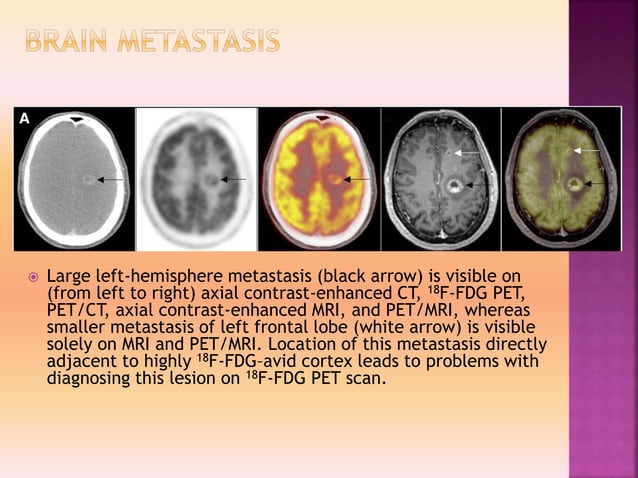 Clinacal applications of PET/CT vs PET/MRI | PPTX