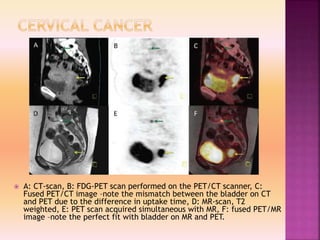 Clinacal applications of PET/CT vs PET/MRI | PPTX