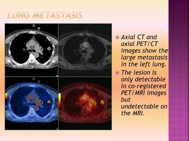Clinacal applications of PET/CT vs PET/MRI | PPTX