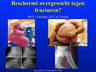 Beschermt overgewicht tegen
        fracturen?
     IWO 3 Oktober 2012 te Utrecht




         em.prof.dr J.C Netelenbos VUmc
 