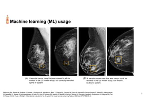 6
Machine learning (ML) usage
McKinney SM, Sieniek M, Godbole V, Godwin J, Antropova N, Ashrafian H, Back T, Chesus M, Corrado GC, Darzi A, Etemadi M, Garcia-Vicente F, Gilbert FJ, Halling-Brown
M, Hassabis D, Jansen S, Karthikesalingam A, Kelly CJ, King D, Ledsam JR, Melnick D, Mostofi H, Peng L, Reicher JJ, Romera-Paredes B, Sidebottom R, Suleyman M, Tse
D, Young KC, De Fauw J, Shetty S. International evaluation of an AI system for breast cancer screening. Nature. 2020 Jan;577(7788):89-94.
(A) A sample cancer case that was missed by all six
readers in the US reader study, but correctly identified
by the AI system
(B) A sample cancer case that was caught by all six
readers in the US reader study, but missed
by the AI system.
 