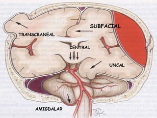 SUBFACIAL
TRANSCRANEAL
AMIGDALAR
UNCAL
CENTRAL
 