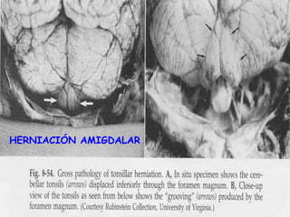 HERNIACIÓN AMIGDALAR
 