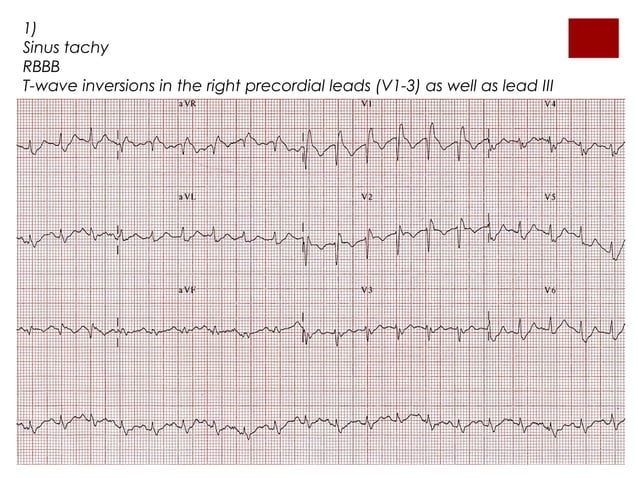 Investigation of suspected pulmonary embolism in pregnancy | PPT | Free