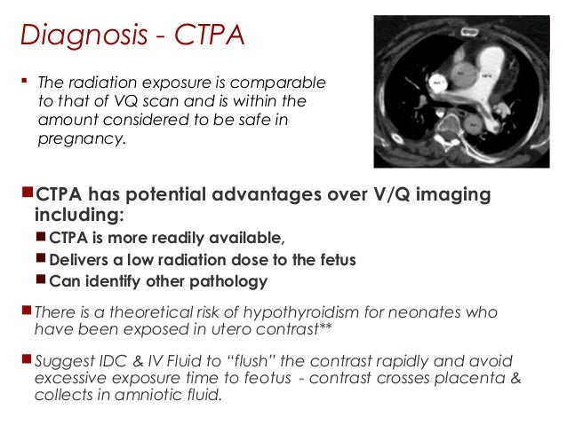 Investigation of suspected pulmonary embolism in pregnancy