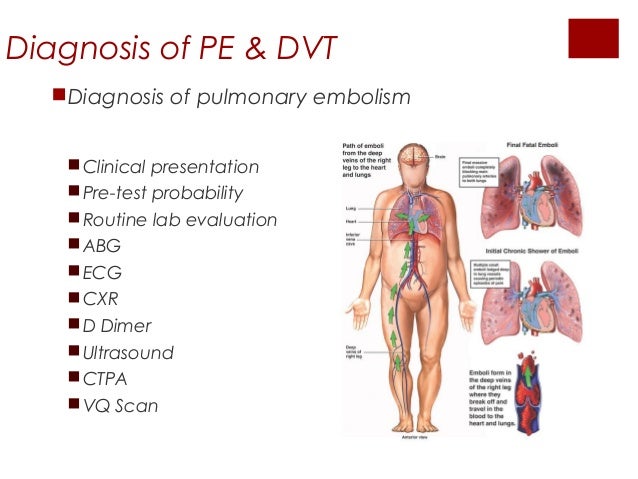 d heart dimer test in of pulmonary suspected pregnancy Investigation embolism d heart dimer test in of pulmonary suspected pregnancy Investigation embolism