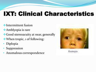 IXT: Clinical Characteristics
Intermittent fusion
Amblyopia is rare
Good stereoacuity at near, generally
When tropic, 1 of following:
• Diplopia
• Suppression
• Anomalous correspondence
 