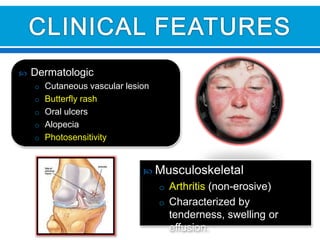  Dermatologic
o Cutaneous vascular lesion
o Butterfly rash
o Oral ulcers
o Alopecia
o Photosensitivity
 Musculoskeletal
o Arthritis (non-erosive)
o Characterized by
tenderness, swelling or
effusion.
 