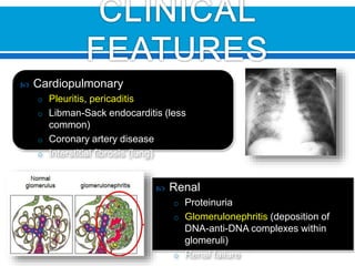  Cardiopulmonary
o Pleuritis, pericaditis
o Libman-Sack endocarditis (less
common)
o Coronary artery disease
o Interstitial fibrosis (lung)
 Renal
o Proteinuria
o Glomerulonephritis (deposition of
DNA-anti-DNA complexes within
glomeruli)
o Renal failure
 