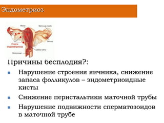 Причины бесплодия?:
 Нарушение строения яичника, снижение
запаса фолликулов – эндометриоидные
кисты
 Снижение перистальтики маточной трубы
 Нарушение подвижности сперматозоидов
в маточной трубе
Эндометриоз
 