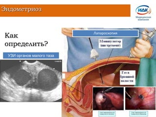 Эндометриоз
Лапароскопия
Как
определить?
УЗИ органов малого таза
 
