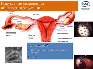 Как оценить?
 Определение уровня гормонов в
крови
 УЗИ
Нарушение созревания
яйцеклетки/овуляции
22
 