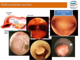 Заболевания матки
26
Гистероскопия
(ГСК)
 