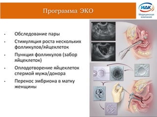 • Обследование пары
• Стимуляция роста нескольких
фолликулов/яйцеклеток
• Пункция фолликулов (забор
яйцеклеток)
• Оплодотворение яйцеклеток
спермой мужа/донора
• Перенос эмбриона в матку
женщины
Программа ЭКО
 