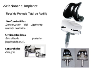 J.M. Hovsepian TKA Soft Tissue Balancing in Total Knee Arthroplasty