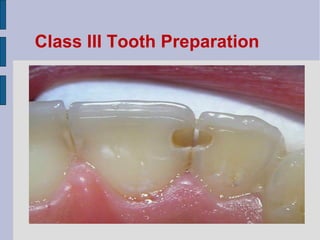 Class III Tooth Preparation 
 