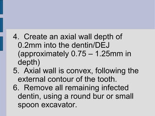 4. Create an axial wall depth of 
0.2mm into the dentin/DEJ 
(approximately 0.75 – 1.25mm in 
depth) 
5. Axial wall is convex, following the 
external contour of the tooth. 
6. Remove all remaining infected 
dentin, using a round bur or small 
spoon excavator. 
 