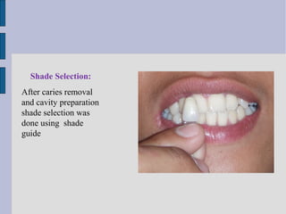 Shade Selection: 
After caries removal 
and cavity preparation 
shade selection was 
done using shade 
guide 
 