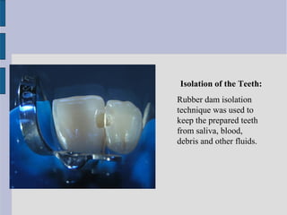 Isolation of the Teeth: 
Rubber dam isolation 
technique was used to 
keep the prepared teeth 
from saliva, blood, 
debris and other fluids. 
 