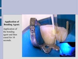 Application of 
Bonding Agent: 
Application of 
the bonding 
agent and then 
cured for 10 
seconds. 
 