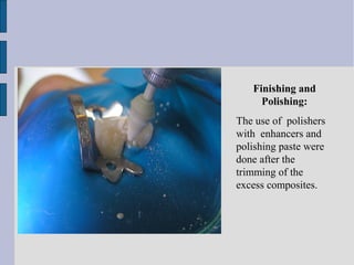 Finishing and 
Polishing: 
The use of polishers 
with enhancers and 
polishing paste were 
done after the 
trimming of the 
excess composites. 
 