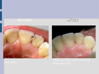 BEFORE AAFFTTEERR 
Before the restoration 
procedure. 
After restoring with Composite 
Resin Material 
