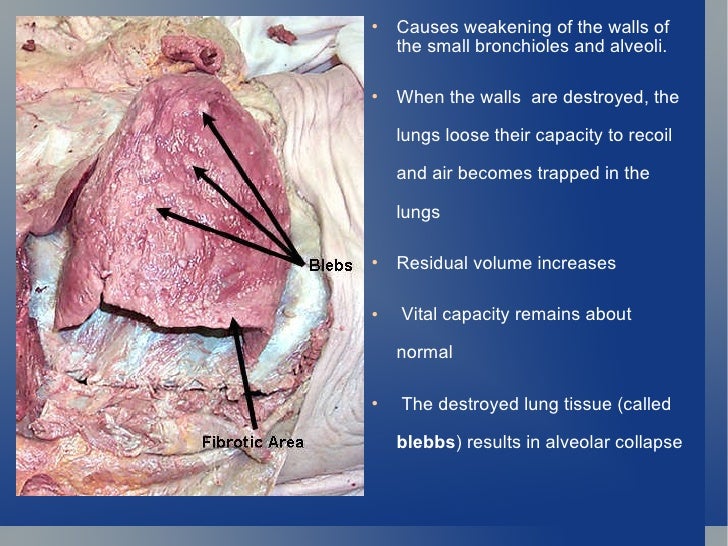 j parker emphysema presentation powerpoint pathophysiology of emphysema flow chart