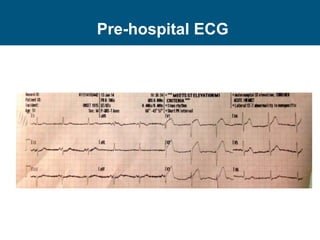 Pre-hospital ECG
 