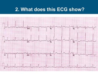 2. What does this ECG show?
 