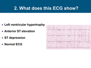 2. What does this ECG show?
 Left ventricular hypertrophy
 Anterior ST elevation
 ST depression
 Normal ECG
 