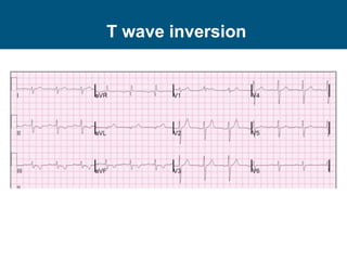 T wave inversion
 