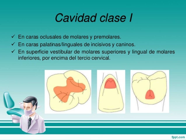 CAVIDADES EN OPERATORIA