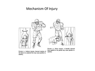 Mechanism Of Injury
 