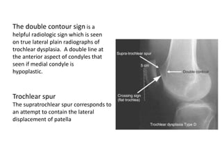 The double contour sign is a
helpful radiologic sign which is seen
on true lateral plain radiographs of
trochlear dysplasia. A double line at
the anterior aspect of condyles that
seen if medial condyle is
hypoplastic.
Trochlear spur
The supratrochlear spur corresponds to
an attempt to contain the lateral
displacement of patella
 