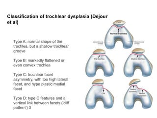 Type A: normal shape of the
trochlea, but a shallow trochlear
groove
Type B: markedly flattened or
even convex trochlea
Type C: trochlear facet
asymmetry, with too high lateral
facet, and hypo plastic medial
facet
Type D: type C features and a
vertical link between facets ('cliff
pattern') 3
Classification of trochlear dysplasia (Dejour
et al)
 
