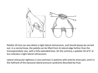 Patellar tilt test can also detect a tight lateral retinaculum, and should always be carried
out. In a normal knee, the patella can be lifted from its lateral edge farther than the
transepicondylar axis, with a fully extended knee. On the contrary, a patellar tilt of 0˚ or
less indicates a tight lateral retinaculum.
Lateral retinacular tightness is very common in patients with anterior knee pain, and it is
the hallmark of the excessive lateral pressure syndrome described by Ficat.
 