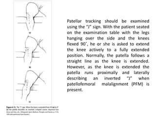 Patellar tracking should be examined
using the “J” sign. With the patient seated
on the examination table with the legs
hanging over the side and the knees
flexed 90˚, he or she is asked to extend
the knee actively to a fully extended
position. Normally, the patella follows a
straight line as the knee is extended.
However, as the knee is extended the
patella runs proximally and laterally
describing an inverted “J” when
patellofemoral malalignment (PFM) is
present.
 