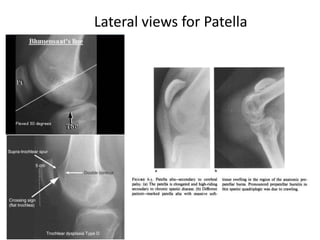 Lateral views for Patella
 
