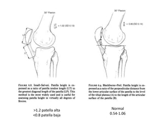 Normal
0.54-1.06
>1.2 patella alta
<0.8 patella baja
 